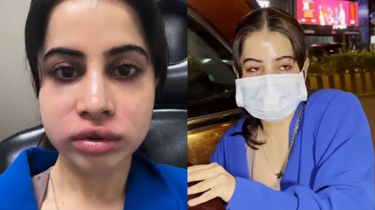 Urfi Javed: उर्फी जावेद का ब्यूटी के लिए दर्दनाक सफर, सूजे होंठ, बिगड़ा चेहरा और अब सच्चाई आई सामने