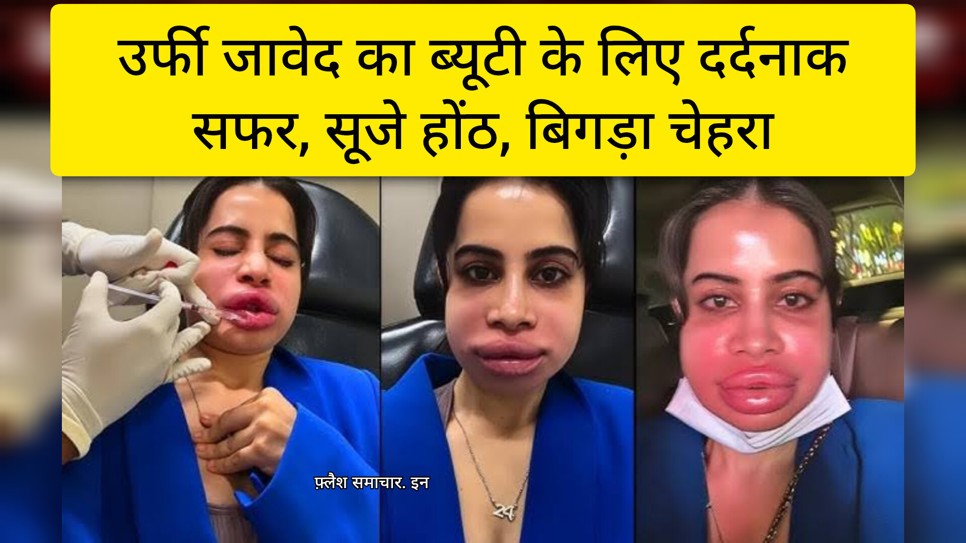 उर्फी जावेद लिप फिलर उर्फी जावेद चेहरा सूजा उर्फी जावेद ब्यूटी इंजेक्शन Urfi Javed lip filler before after