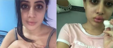 सावधान रहो: लिप फिलर से नुकसान हो सकता है, उर्फी जावेद की दर्दनाक कहानी